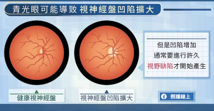 青光眼系列（一）青少年也容易患上青光眼-新华网